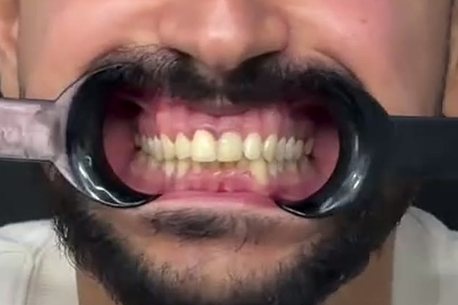 חיוך לפני התקנת הציפויים
